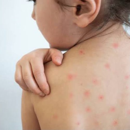 Sarampo volta a preocupar o Brasil e coloca vacinação em alerta; Goiás está há 6 anos sem casos